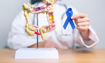 Phases of Stomach Cancer Disease