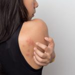 Can One Get Skin Cancer Itch? Dealing With Symptoms