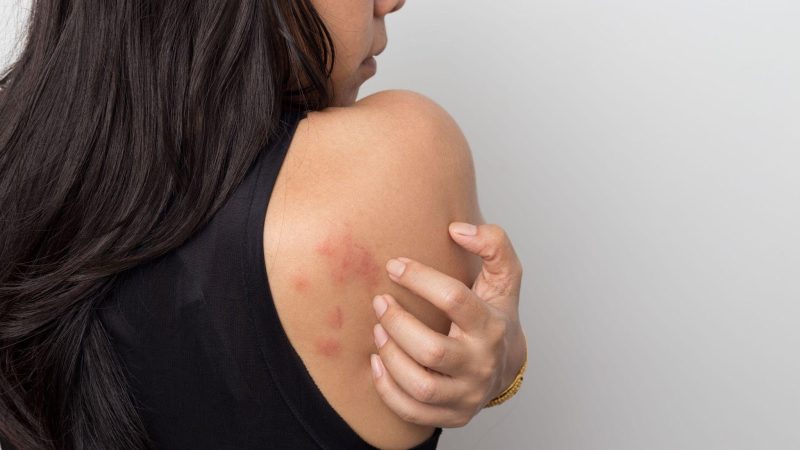 Can One Get Skin Cancer Itch? Dealing With Symptoms