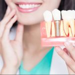 How Dental Implants Enhance Your Appearance