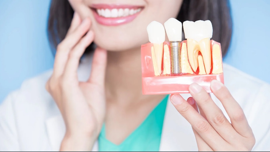 Dental Implants
