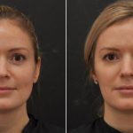 How Long Botox Results Last and When to Re-Treat