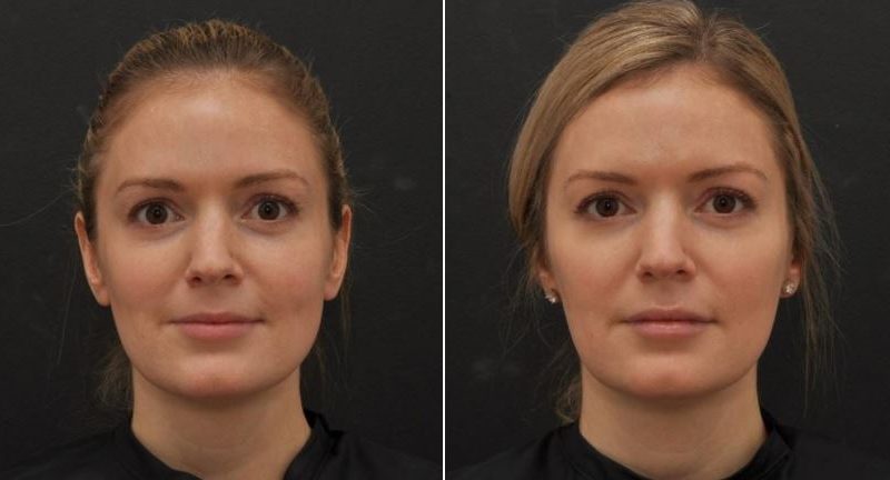 How Long Botox Results Last and When to Re-Treat